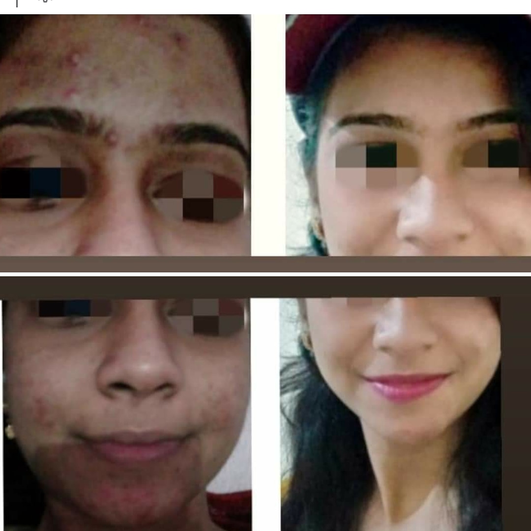 Before After Skin Treatment